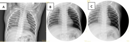 Figure 6 1-year 6 month-old boy presented to the hospital with coughing and wheezing for 1 month after choking on a meal. At the time of presentation, the breath sounds of the left lung were reduced on auscultation with chest X-ray and chest fluoroscopy showing increased translucency of the left lung. Bronchoscopy was performed with several pieces of crushed peanuts noted and removed from the left main bronchus.