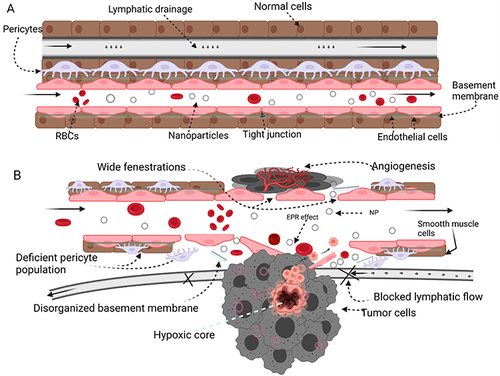 Figure 6 Nanoparticle – guided journey: The microenvironment of (A) healthy and (B) tumor tissues are compared. The chaotic components of the tumor microenvironment (hypoxic core, obstructed lymphatic drainage, insufficient pericyte population, disorganized basement membrane, and broad fenestration are used to enhance the EPR effect.