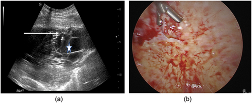 Figure 2. Pleural biopsies using A) cutting needle under ultraound guidance and B) thoracoscopic technique. Arrow indicates position of cutting needle, star indicates pleural effusion.