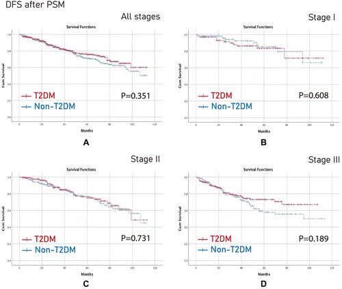 Figure 5 DFS after PSM. (A) All stages; (B) Stage I; (C) Stage II; (D) Stage III.