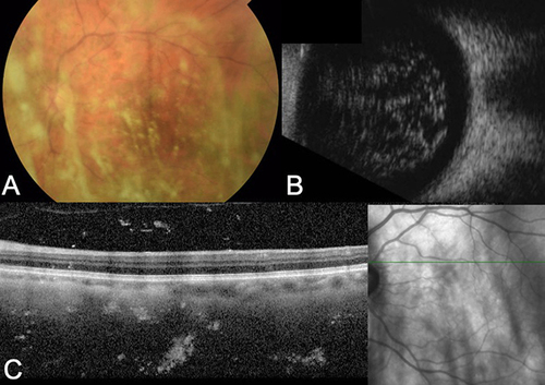 Figure 2 (A) Fundus photography, (B) B-scan, and (C) OCT imaging of asteroid bodies in an eye with asteroid hyalosis.