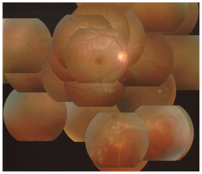 Figure 2 Photograph of the fundus of the right eye postoperatively. The entire retina is reattached.