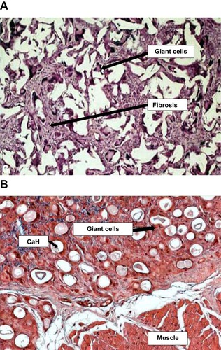 Figure 2 Urethral tissue interaction with the particulate bulking agents. (A) A high-power view to show the florid foreign-body type inflammatory reaction, with interparticle giant cells and fibrosis (H&E ×60);Citation50 (B) transverse histological section of the vocal fold injected calcium hydroxyapatite (CaH) after 3 weeks of the procedure. Observe multinucleated giant cells involving the injected material (×400). Reproduced from Vasconcelos SJ, Leão RA, Bernardino-Araújo S, Lira MM, Tsuji DH. Effect of sugarcane biopolymer in vocal fold of rabbits. Comparative study with calcium hydroxyapatite. Acta Cir Bras. 2015;30(3):186–193.Citation51