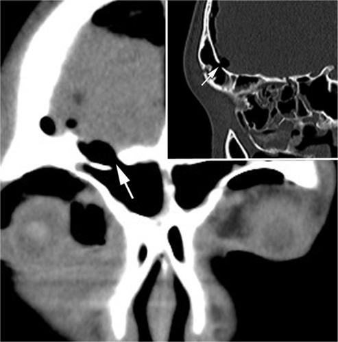 Figure 2 CT image in the coronal and sagittal plane.