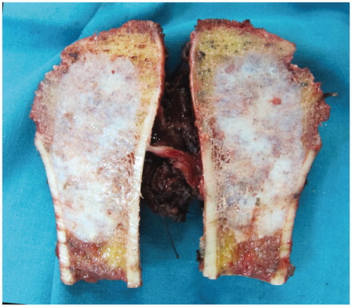 Figure 6. The anatomical specimen of a low-grade chondrosarcoma of the proximal humerus, showing the small wide margin achieved.