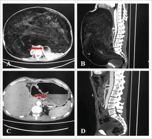Figure 2. A and B: Abdominal computed tomography (CT) shows a heterogeneous retroperitoneal mass occupying the entire abdominal cavity, with stomach being pushed aside (red arrow). C and D: The 3-month follow-up CT scan, with the normal stomach (red arrow).