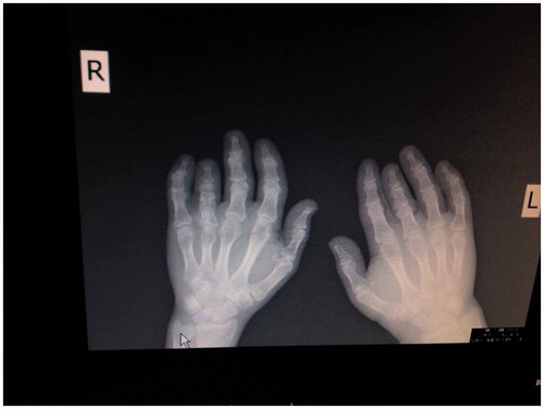 Figure 1. Brachydactyly in bilateral fingers.