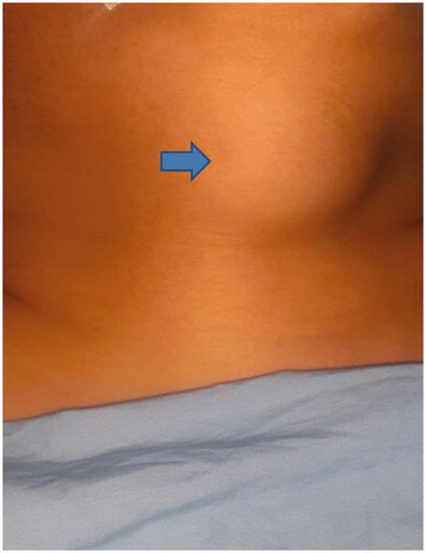 Figure 1. Preoperative showing the presence of cystic lesion above the hyoid bone (supra hyoid thyroglossal cyst).