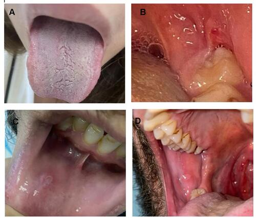 Figure 1 Forms of oral manifestations among patients with oral symptoms (N=58) (A) Coated tongue, (B) Gingival erythema, (C) Ulcer, and (D) blister.
