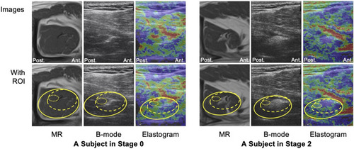 Figure 2 The cross-sectional measurement areas of the AM-p (the dotted circler area), AR (the dashed circler area) and whole (the solid circler area) of the supraspinatus.