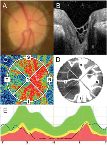 Figure 1. Multimodal imaging of the ONH in RP. (A) The color of the ONH was evaluated using fundus photographs. (B) The presence of a hyper-reflective structure on the ONH was evaluated using 31 volume slices of OCT images. (C) The blood flow was evaluated using LSFG. The colors in the LSFG map represent the average MBR during a single heartbeat. Warmer colors represent a higher MBR, and cooler colors represent a lower MBR. (D) Images were inverted into binary images to evaluate the blood flow in the vessel (white area) and tissue (black area). (E) The thickness of the RNFL was evaluated around the ONH.ONH, optic nerve head; RP, retinitis pigmentosa; OCT, optic coherence tomography; LSFG, laser speckle flowgraphy; MBR, mean blur rate; RNFL, retinal nerve fiber layer.