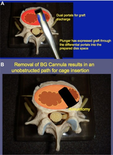 Figure 6 Axial view of the prepared disk space during and after application of the bone graft delivery tool.