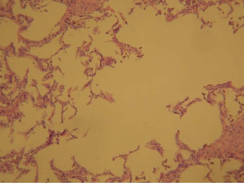 Figure 1 Photomicrographs of emphysematous lung parenchyma showing hyperdistension of alveolar ducts, increased number and size of alveolar fenestrae with marked destruction of alveolar septa (H&E) ×100 increased (by courtesy of Dr Jelena Stojsic).