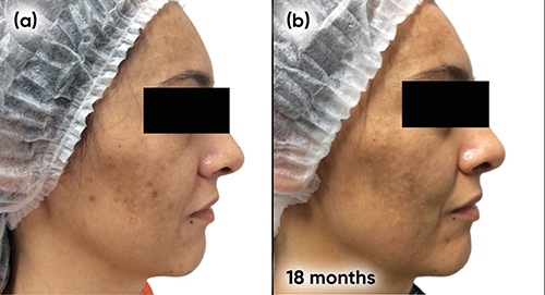 Figure 7 Case study 3 improvement right side, baseline to 18 months (a) Baseline following 9 months with spironolactone 50mg twice a day plus AZA 15% gel twice a day (b) 9 months with spironolactone 25mg twice a day plus AZA 15% gel twice a day.