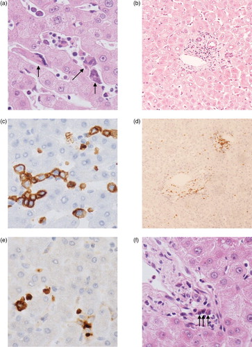 Figure 3. Tri-lineage extramedullary haematopoiesis in the donor liver. (a) Extramedullary haematopoiesis (original magnification ×50). Three megakaryocytes highlighted with arrows. (b) Lymphocytes around the portal tract (×10). (C) Erythroid precursors stained with glycophorin C (×50). (D) Lymphocytes present in the parenchyma and around the portal tract with CD3 (×10). (E) Myeloid precursors stained with myeloperoxidase (×50). (F) Three plasma cells in the portal tract highlighted with arrows (×50).