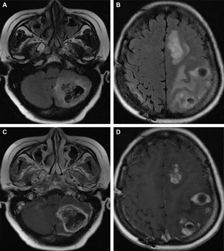 Figure 3 MRI comparison between pre- and post-apatinib for patient 1.