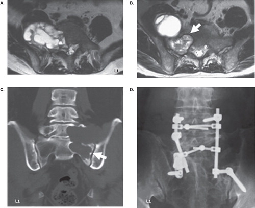 Figure 2. Case 5. Axial images of T2-weighted MRI at L5 level (A) and S1 level (B) showing bony destruction of the vertebral body and a tumor involving the intraosseous area of S1 (white arrow) and presacral region. Frontal reconstruction of CT (C) showing obvious bony destruction of the L5 body, sacrum, and sacroiliac joint (white arrow). Partial tumor excision was done using the posterior approach, and lumbopelvic fixation and bone grafting were performed (D).