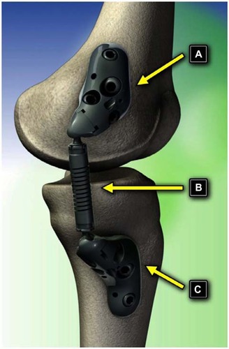 Figure 1 Components of the KineSpring System. (A) Femoral base, (B) absorber, and (C) tibial base.