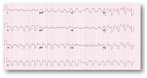 Figure 2. Wide complex tachycardia at a rate of 121 bpm that is consistent with ventricular tachycardia.