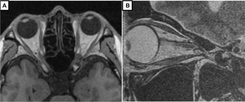 Figure 5 MRI images after FSRT for ONSM.