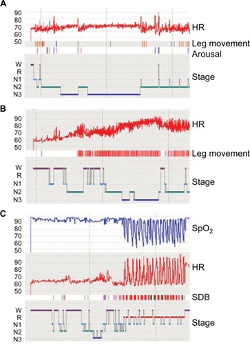 Figure 1 Examples of HR patterns from clinical PSGs.