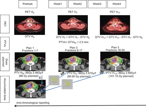 Figure 1. Design of the adaptive dose escalation procedure. For each planning phase, separate image sets (i.e. PET CT H0, PET CT H7 and PET CT H17) were acquired. Using deformable image co-registration, regions-of-interest were deformed from one PET-CT to the next and manually adjusted when needed. For each phase, a new treatment plan was made only on the newborn voxel of that phase (i.e. at the 7th and 17th fraction). The doses were summed anti-chronologically on the pretreatment PET-CT.