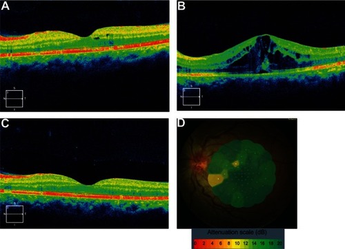 Figure 2 Optical coherence tomography (OCT) (A) shows marked improvement of retinal swelling and cystoid macular edema (CME) at 2 weeks after the first intravitreous injection of bevacizumab. OCT (B) reveals the recurrence of macular edema at 3 months after intravitreous anti-vascular endothelial growth factor (VEGF) therapy. OCT (C) displays marked improvement of retinal swelling and CME at 1 week after the second intravitreous injection of bevacizumab. Fundus-monitored microperimetry with the MP-1 system (D) demonstrates improvement of foveal sensitivity.