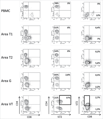 Figure 2. Representative dot plots of the results obtained by flow cytometry analysis for ILT2 cell-surface expression on CD8+ and CD4+ T cells from PBMC and 4 different tumor areas in patient #8 are shown. Tumor-infiltrating cells were obtained after mechanic disruption followed by enzymatic digestion of 4 different areas from the surgically-resected tumor (T1, T2, G, VT). PBMC and tumor infiltrating cells from each tumor area were stained with conjugated-antibodies directed against CD3, CD4, CD8, and ILT2 and were then analyzed by flow cytometry. Percentages of both ILT2-positive and ILT2-negative populations gated on CD3+ T cells are indicated. G, metastatic hilar lymph node; VT, tumoral thrombus of the renal vein