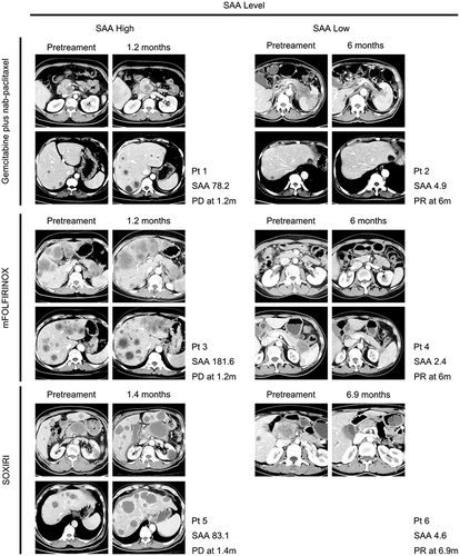 Figure 6 Representative CT images. (Patient 1 #) A patient with SAA of 78.2 mg/L received AG. CT examination before chemotherapy showed that the patient had primary tumor located in the head of the pancreas and multiple metastases in the liver. After 1.2 months of chemotherapy, the size of the pancreatic lesion enlarged, and intrahepatic metastases increased and enlarged. The efficacy was evaluated as PD. (Patient 2 #) A patient with SAA of 4.9 mg/L received AG. CT examination before chemotherapy showed that the patient had primary tumor located in the tail of the pancreas and multiple metastases in the liver. After 6 months of chemotherapy, the size of the pancreatic lesion and intrahepatic metastases were smaller. The efficacy was evaluated as PR. (Patient 3 #) A patient with SAA of 181.6 mg/L received mFOLFIRINOX. CT examination before chemotherapy showed that the patient had primary tumor located in the tail of the pancreas and multiple metastases in the liver. After 1.2 months of chemotherapy, the pancreatic lesions were stable in size, but intrahepatic metastases increased and enlarged. The efficacy was evaluated as PD. (Patient 4 #) A patient with SAA of 2.4 mg/L received mFOLFIRINOX. CT examination before chemotherapy showed that the patient had primary tumor located in the tail of the pancreas and peritoneal metastases. After 6 months of chemotherapy, the size of the pancreatic lesion was smaller and peritoneal metastases were smaller and partially disappeared. The efficacy was evaluated as PR. (Patient 5 #) A patient with SAA of 83.1 mg/L received SOXIRI. CT examination before chemotherapy showed that the patient had primary tumor located in the neck and body of the pancreas and multiple metastases in the liver. After 1.4 months of chemotherapy, the size of the pancreatic lesion enlarged, and intrahepatic metastases increased and enlarged. The efficacy was evaluated as PD. (Patient 6 #) A patient with SAA of 4.6 mg/L received SOXIRI. CT examination before chemotherapy showed that the patient had primary tumor located in the head of the pancreas and intrahepatic metastases. After 6.9 months of chemotherapy, intrahepatic metastases disappeared, the pancreatic lesion was treated with irreversible electroporation.