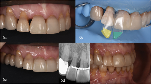 Figure 6. Clinical case IV. (a) Initial intraoral lateral view. (b) Detail of the isolated teeth. The largest yellow and green specific matrices for black triangles were selected (black triangle kit. Bioclear matrix systems. Bioclear). (c) Two weeks clinical control (d) Radiographic control at two weeks. (e) Two years review, highlighting the restoration integrity.