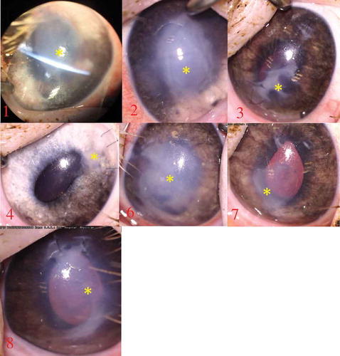 Figure 1. Photography at one month showing retrocorneal membrane/fibrosis formation in all eyes (yellow asterisk). In minipig 4 there is only a small membrane located around the main incision