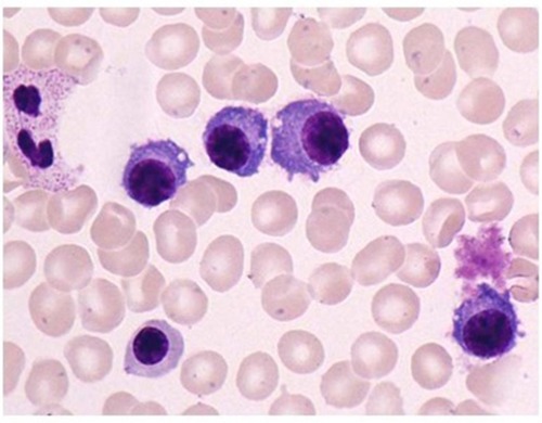 Figure 5 Bone marrow aspiration smear (May–Giemsa staining, ×1,000). Note: The frequency of plasma cells was 30% of all nucleated cells.