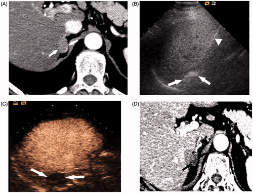 Figure 3. MWA in a 68-year-old female with an aldosterone-secreting adenoma on the right side of the adrenal gland. (A) Enhanced CT before the ablation treatment demonstrated obvious enhancement of a nodule (arrow) adjacent to both the right posterior lobe of the liver and the diaphragmatic crus. (B) Ultrasonograph during the ablation procedure showed the antenna placement (arrow) and the hyperechoic region covering the entire target lesion (arrow head). (C) CEUS 2 days after the procedure displayed no enhancement in the ablation zone (arrow) and no injury to the diaphragm. (D) Enhanced CT imaging 6 months after MWA showed a completely necrotising area (arrow).