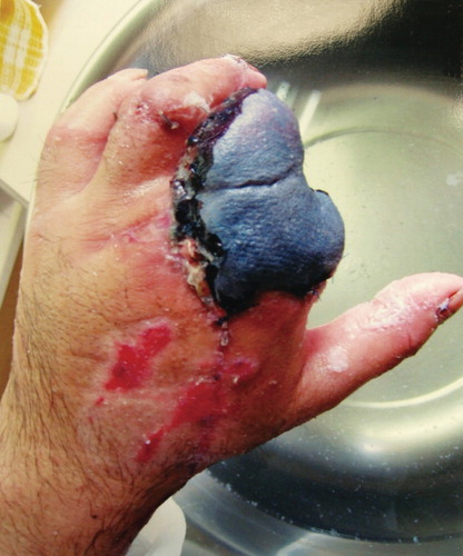 Figure 1. Photograph taken by the patient showing a pedicled reverse forearm flap that totally failed to cover the stumps.
