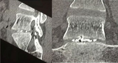 Figure 4 Fluoroscopic image demonstrating the tungsten contrast material within the intervertebral disc, indicating adequate placement of the ethanol gel injection.