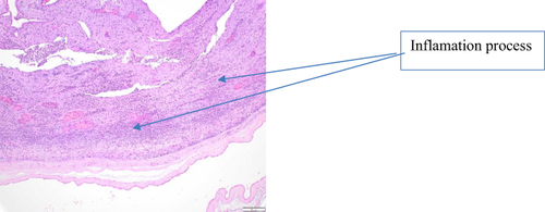 Figure 1 Diffuse intense inflammation with microabscesses in placental chorionic plate. HE x200. Small foci of purulent villitis in which groups of acutely inflamed villi are surrounded by fibrin and an acute peri-villous and intervillous inflammatory exudate.