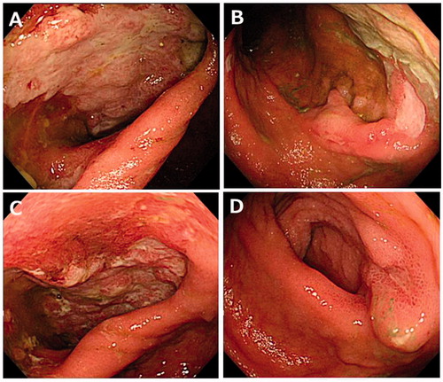 Figure 3. Endoscopic findings showed active ulcerations of the pouch and anastomotic site on the 34th day after admission (A, B). After treatment with oral tacrolimus, the endoscopic findings dramatically improved on day 78 after admission (C, D).