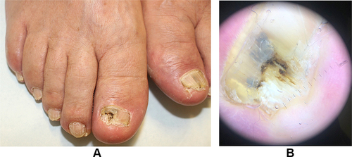 Figure 2 Patient with laboratory confirmed onychomycosis. (A) Clinical appearance of toenails with onycholysis, nail plate thickening and subungual debris. (B) Dermoscopy showing ruin-like appearance and streaks of various colors.