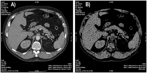 Figure 2. Left to right: (A) The axial computed tomography (CT) image was taken from the T12 vertebra spinous process level. (B) Measurement of the erector spinae muscle area (ESMa) on the axial CT section (window length, 40; window width, 300 HU). The threshold was set at −29 to +150 HU. ESMa was manually drawn on both sides using freehand regions of interest.