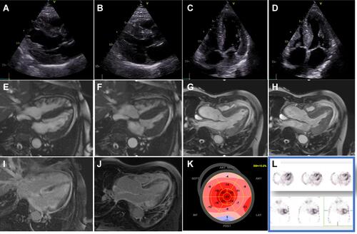 Figure 2 Echocardiography shows the presence of septal asymmetric hypertrophy (A–D) with preserved ejection fraction. In addition, strain polar maps show apical sparing (K). Further diagnostic work-up using CMR confirmed asymmetric LV hypertrophy (E–H) and showed transmural LGE of the LV, RV, the atria, and the interatrial septum (I and J). In addition, serum, and urine immunofixation showed no monoclonal free light chains, and suspicion of ATTR amyloidosis was confirmed using bone scintigraphy, which exhibited strong tracer uptake (L).