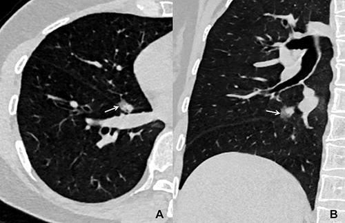 Figure 3 A patient with invasive adenocarcinoma. (A) axial and coronal (B) CT images show a solid nodule located in the right middle lobe, and there is partial and well-defined ground glass opacity (halo sign) in its periphery (arrow).