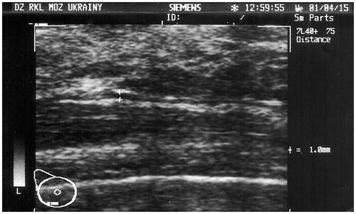 Figure 3. Ultrasonography of the breast with the ruptured PIP implant after implant removal. The remnant xanthoma tissue is visualized as 1 mm hypoechogenic mass (marked by white crosses)