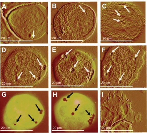 Figure 4 HL60/AR cells were cultured with DPV576 (10% V/V) for 24 hours then exposed to DNR (2 μM) for 45 minutes. Cytospin preparations of cells under different treatment conditions were air dried, fixed in MeOH, and prepared for AFM studies. Preparation showed no significant changes in hole formation in control cells untreated with DNR and DPV576 (A) and DNR only treated (B). DPV576 only treated (C) showed an increase in the number of holes. Preparation of DPV576 plus DNR treated cells (D–F) showed more frequent and larger-sized holes (white arrows). Contrast images of (D and E) correspond to (G and H), respectively, and regions in dark orange indicate the depth of the holes (black arrows). Finally, (I) shows an apoptotic cancer cell with signs of membrane blebbing.Abbreviations: AFM, atomic force microscopy; DNR, daunorubicin.