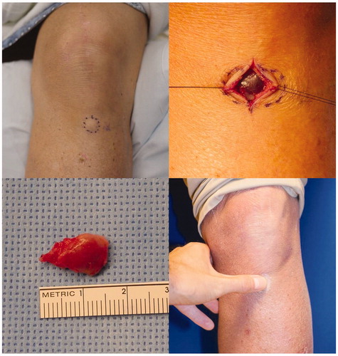 Figure 1. Pre-operative knee with tumor outlined, in situ and resected tumor, post-operative tolerance of pressure over prior tumor site and surgical scar.