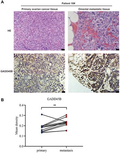 Figure 7 GADD45B is overexpressed in omental metastatic tissues of EOC over matched primary tumour tissues. (A) Representative images of the immunohistochemical analysis of GADD45B in one of the paired tumour tissues. Scale bar, 20 μm. (B) Statistical result of the mean density of GADD45B in 11 pairs of matched EOC tissue samples. Paired Student’s t-test was used to analyse the data (**p < 0.01).