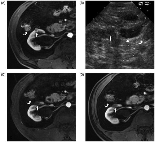 Figure 1. A 67-year-old man with histopathologically a proven clear cell carcinoma renal tumour on the right side. (A) Transverse contrast enhanced MRI reveals a 1.3-cm hypoenhancement tumour (arrow) located on the ventral side of the right kidney adjacent to the colon (curve arrow) before the MWA. (B) After the saline injection hydrodissection (solid triangle), the colon (curve arrow) is successfully separated from the renal tumour (arrow) on US imaging. (C) Transverse contrast-enhanced MRI 3 months after the MWA reveals that the tumour adjacent to the colon (curved arrow) is completely ablated (arrow). (D) Transverse contrast-enhanced MRI 6 months after the MWA reveals the completely ablated tumour (arrow) adjacent to the colon (curved arrow) shrinkage.