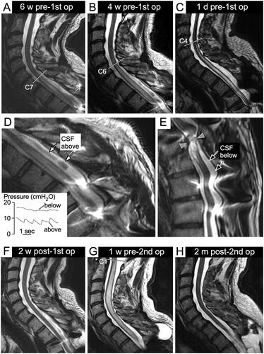 Figure 1. MRI spine. T2 mid-sagittal view at (A). Six weeks before first surgery (duroplasty + arachnolysis) (B). Four weeks before first surgery (C). One day before first surgery (D). CSF above (E). CSF below injury site. Arrows: white (CSF pulsation artefact), black (no CSF pulsation artefact), grey (injury site). D-Inset: CSF pressure simultaneously monitored during first surgery above and below the injury site; patient supine before dural opening. T2 mid-sagittal view (F). Two weeks after first surgery (G). One week before second surgery (more extensive duroplasty and arachnolysis) (H). Two months after second surgery.