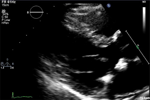 Figure 1. Trans-esophageal echocardiogram revealing a mass on the posterior leaflet of mitral valve.