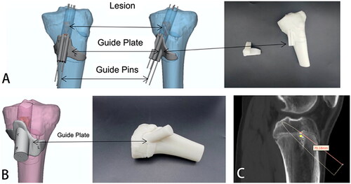 Figure 6. (A) Accurate positioning and placement of steel needle and lesion range simulated by guide plate (Regimen 1); (B) Accurate positioning and placement of steel needle and lesion range simulated by guide plate (Regimen 2); (C) The length from the physis of the tibia to the tail end of the steel needle was 7 cm.