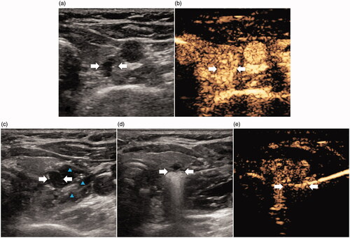Figure 1. Images show ablation of pHPT nodule in a 47-year old female. (a) A hypoechoic pHPT nodule with sharp boundary (arrows) was behind superior right lobe of thyroid on US. (b) Uniform hyperenhancement of pHPT nodule (arrows) in arterial phase on CEUS. (c) Establishment of hydrodissection (blue arrow) around pHPT nodule (arrows). (d) Ablation procedure of pHPT nodule (arrows): hyperechoic area emerging inside nodule. (e) After ablation, non-enhancement area covered pHPT nodule (arrows) on CEUS. CEUS: contrast-enhanced US; pHPT: primary hyperparathyroidism; US: ultrasound.
